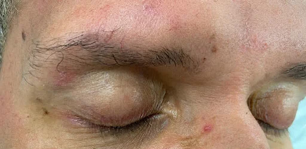 Antes — correção de falhas com micropigmentação de sobrancelhas